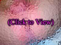 Diaper Rash Picture Baby 3 Thumbnail image