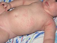 Baby Heat Rash Picture 3 Thumbnail image