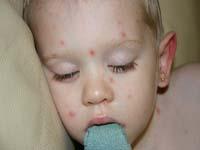 Chicken Pox Picture Baby 3 Thumbnail image