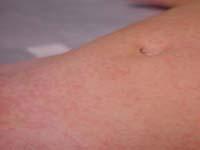 Baby Viral Rash Picture 3 Thumbnail image