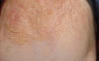 Cradle cap 10