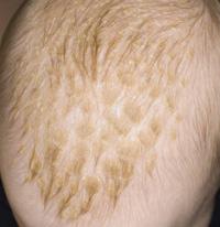 Cradle cap 11