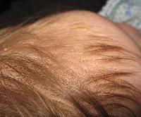 Cradle cap 12