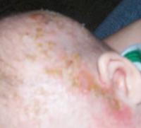Cradle cap 13