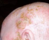Cradle cap 14