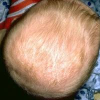 Cradle cap 15