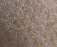 Cradle cap 2