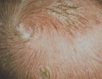 Cradle cap 3