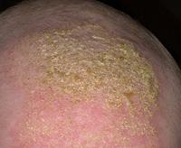 Cradle cap 4