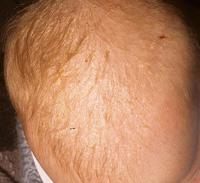 Cradle cap 5