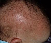 Cradle cap 6