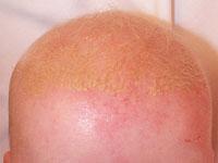 Cradle cap 7