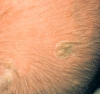 Cradle cap 8