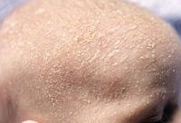 Cradle cap 9