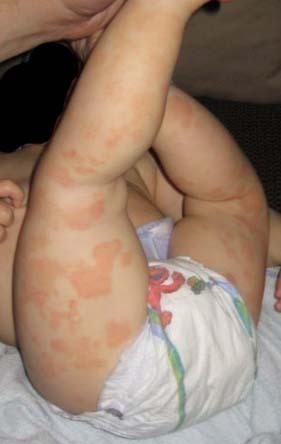 teething rashes. Chickenpox Rash