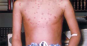 Chickenpox