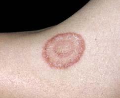 Ringworm