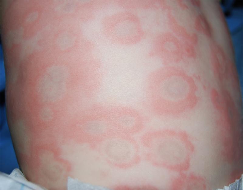 Baby Hives | Causes, Symptoms and Cures of Baby Hives