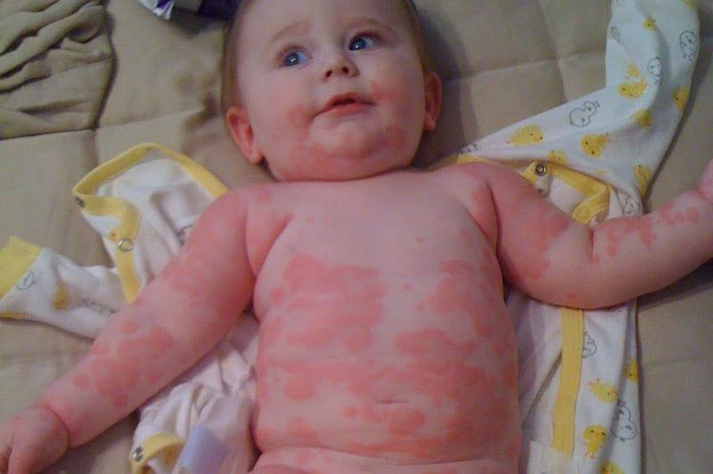 hives on babies #10