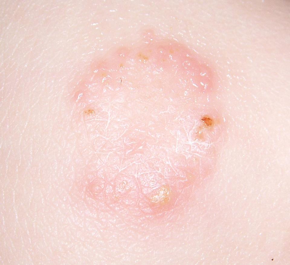 ringworm rash image