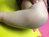 ringworm rash on baby