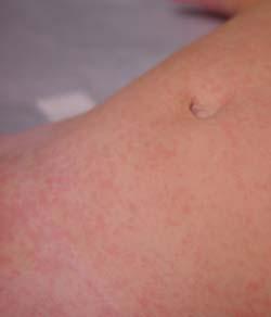 Baby Rashes and Skin Care Topics - WebMD
