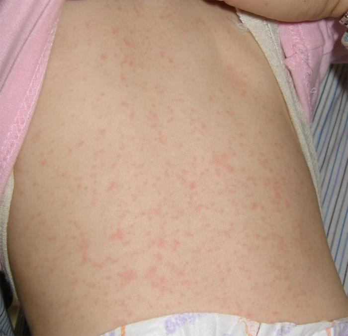 what viruses cause hives in toddlers