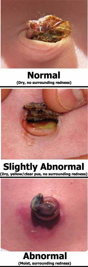 normal abnormal infected umbilical cord