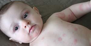 Baby allergies discussed, causes and treatment options ...