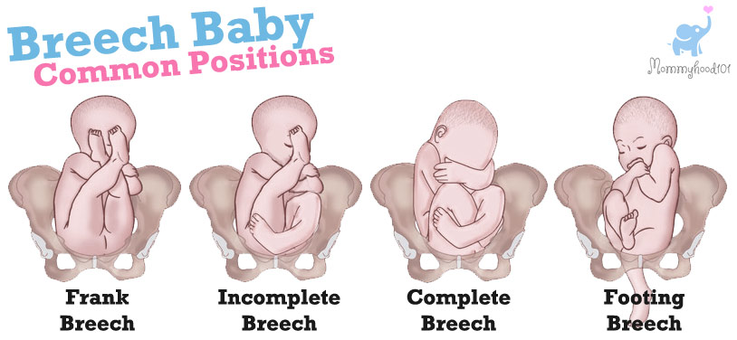 breech baby positions frank footing complete incomplete