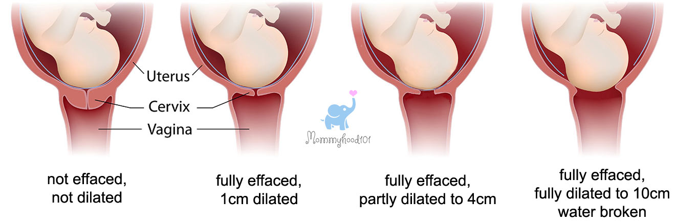 cervical dilation effacement water break early signs of labor