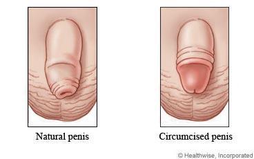 circumcised penis