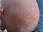 How to get rid of cradle cap. Causes and treatments. - Mommyhood101