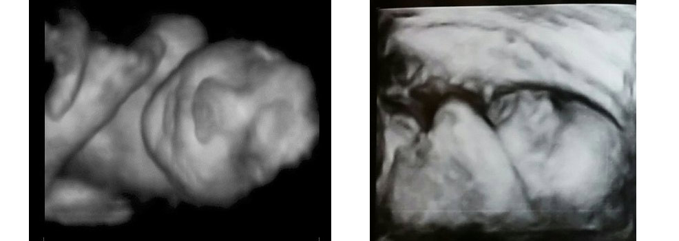 fetus face visualization 3d ultrasound pregnancy