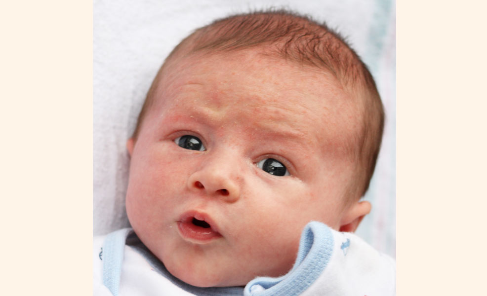 baby with acne on face