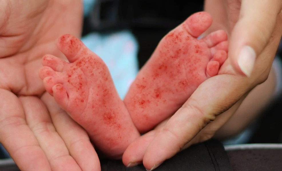 baby with hand foot mouth rash on bottom of feet