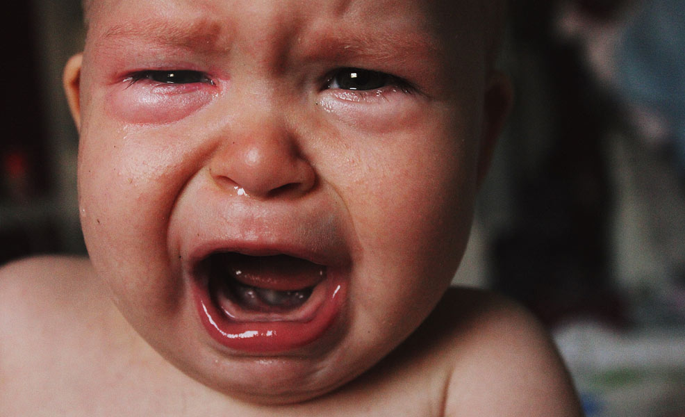 baby crying with a blocked tear duct