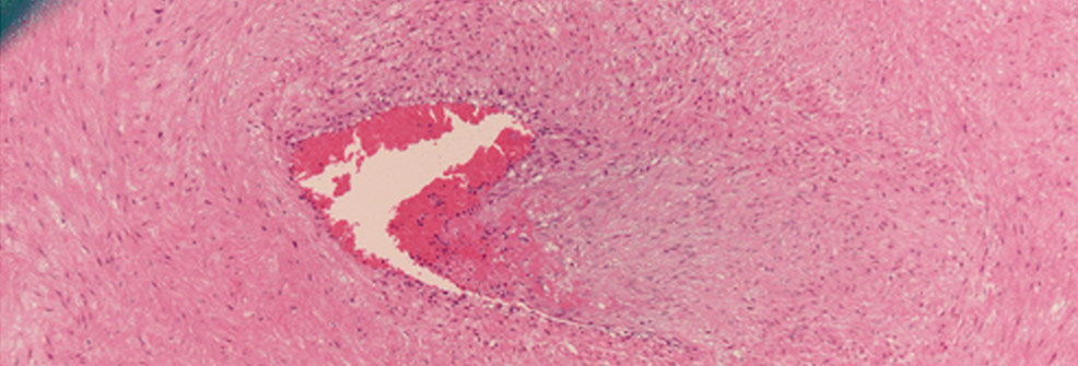 placenta abnormalities pregnancy covid-19