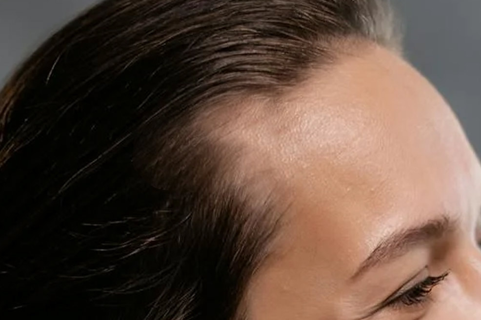 thinning hair on new mom postpartum