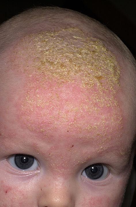 4 Natural Cradle Cap Cures I Stay at Home Mum