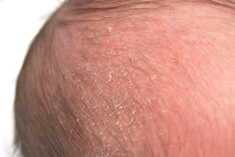 Baby cradle cap pictures, symptoms, causes, and treatments. - Mommyhood101