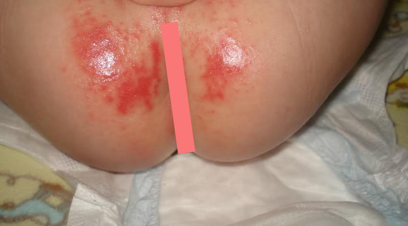Diaper Rash - Types, Causes and Treatment for Baby Diaper Rash