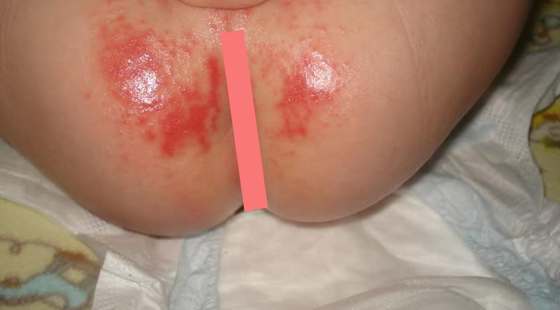 Baby Rash Pictures Causes Treatments Mommyhood101