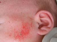 eczema rash on baby