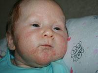 eczema rash on baby