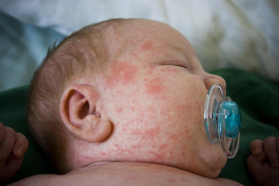 dealing-with-heat-rash-on-babies-heat-rash-baby-rash-baby-heat-rash