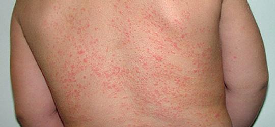 Baby Rash Pictures Causes Treatments Mommyhood101