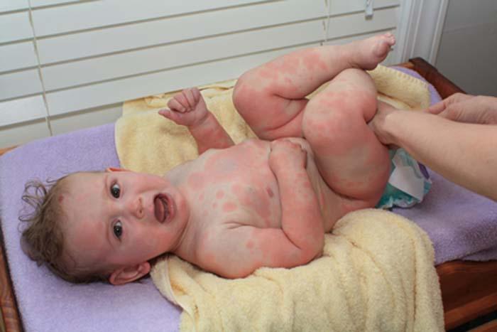 can amoxicillin cause a diaper rash in toddlers