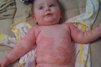 hives on baby