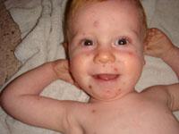 chickenpox rash on baby